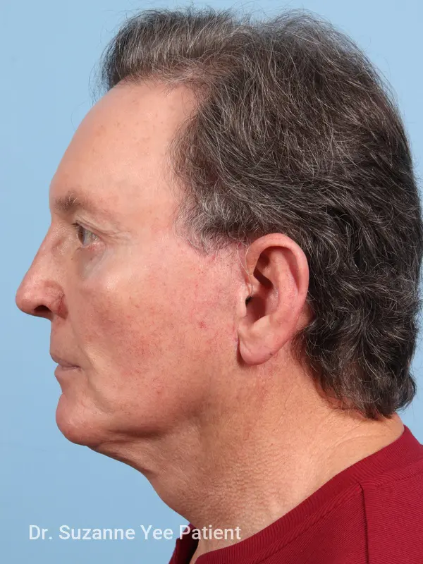 Facelift Patient Photo - Case 23503 - after view-2