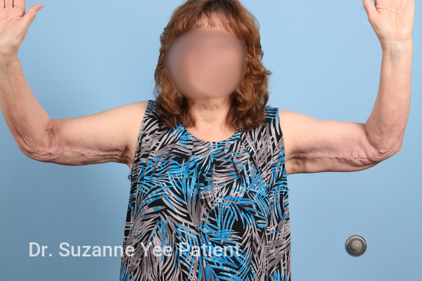 Arm Lift Patient Photo - Case 23527 - after view