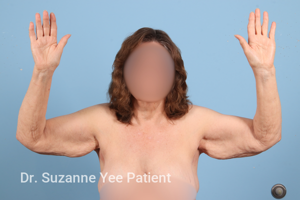 Arm Lift Patient Photo - Case 23527 - before view-