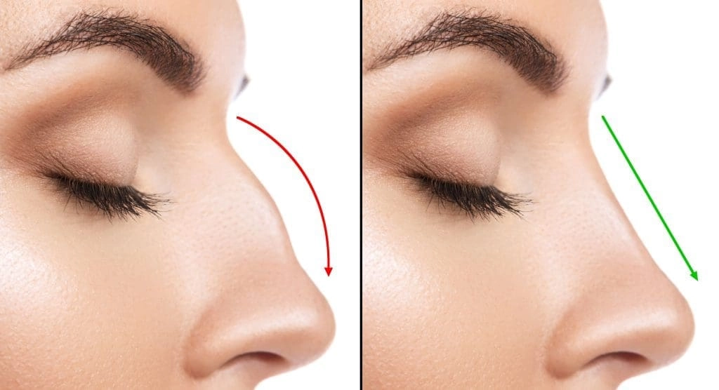 The History of Rhinoplasty