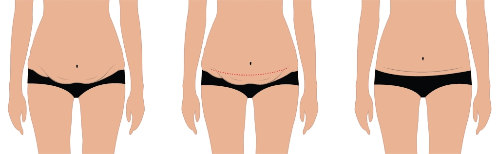 Tummy Tuck Scars: Expectations and Care