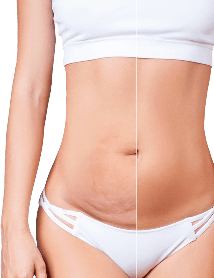 Flatten the Stomach with a Tummy Tuck after Pregnancy