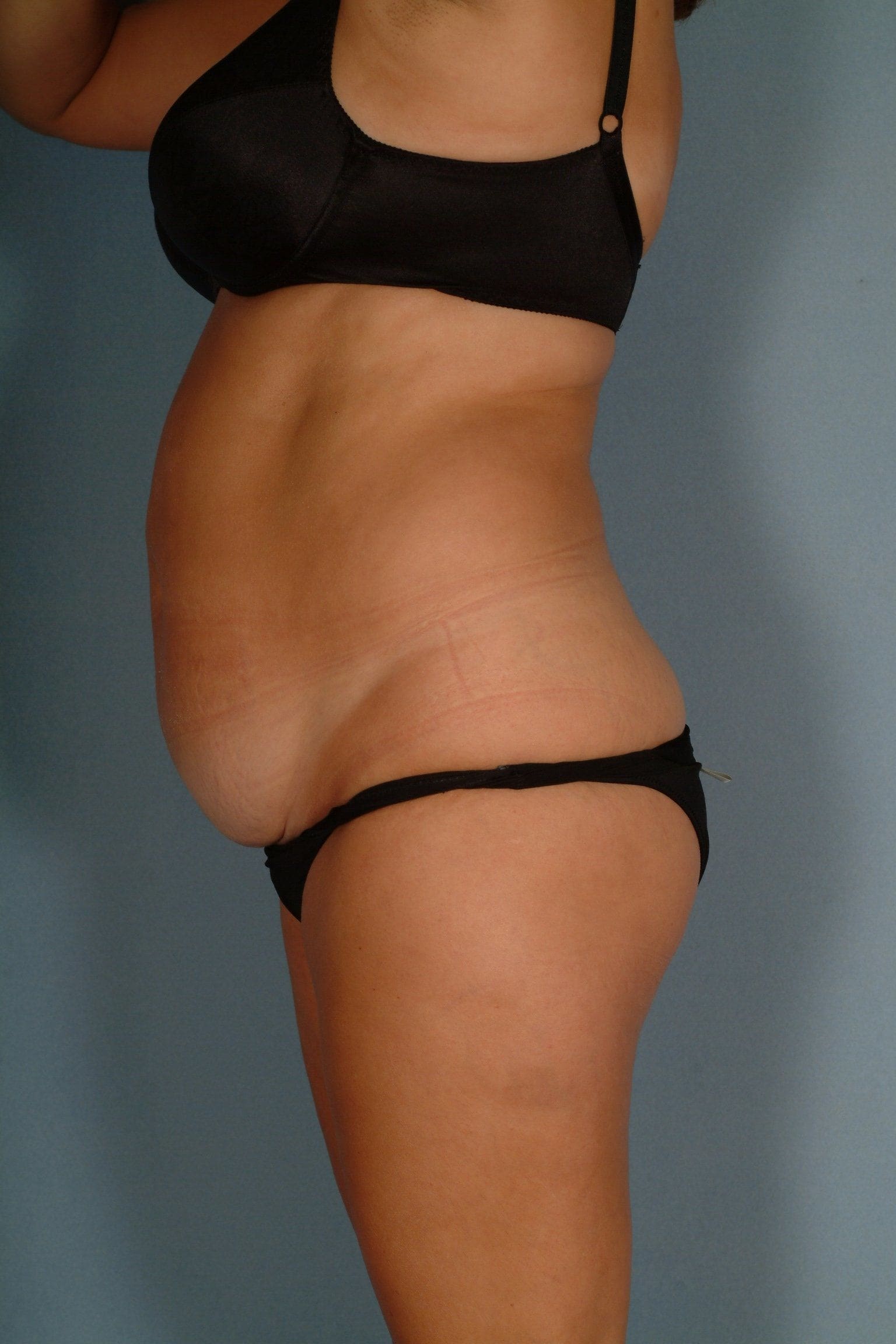 Abdominoplasty Patient Photo - Case 11750 - before view-3