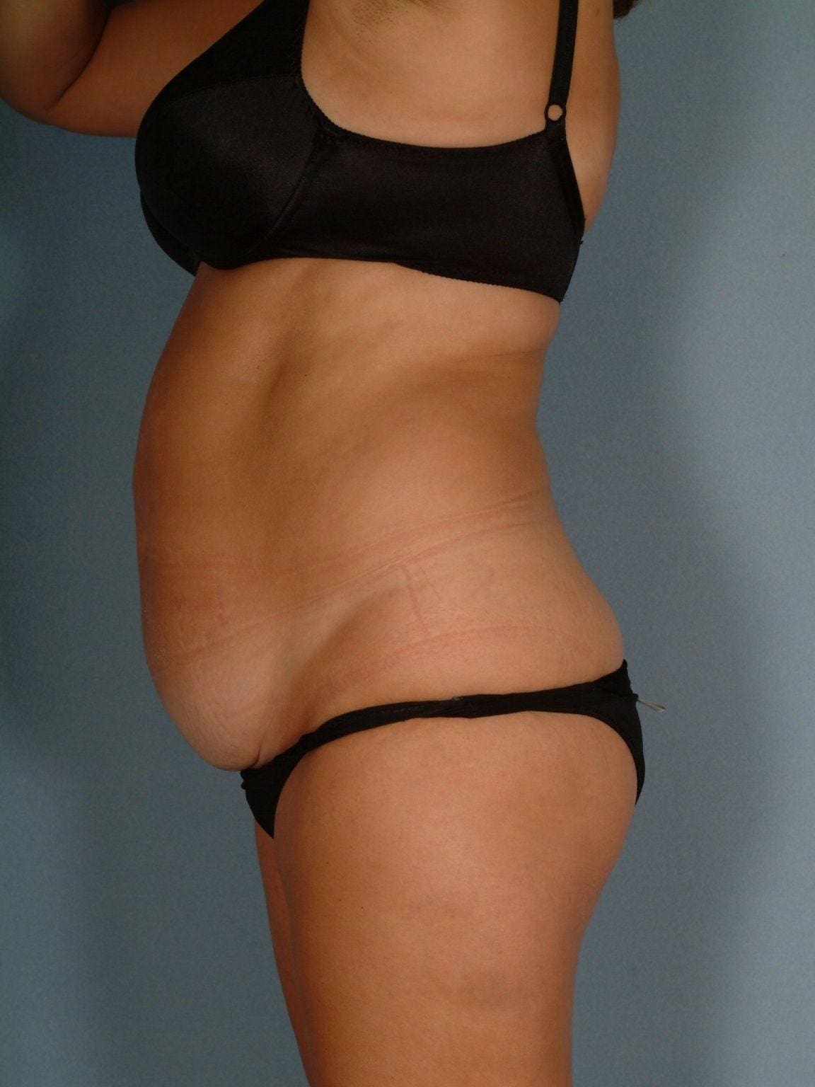 Abdominoplasty Patient Photo - Case 11750 - before view-1