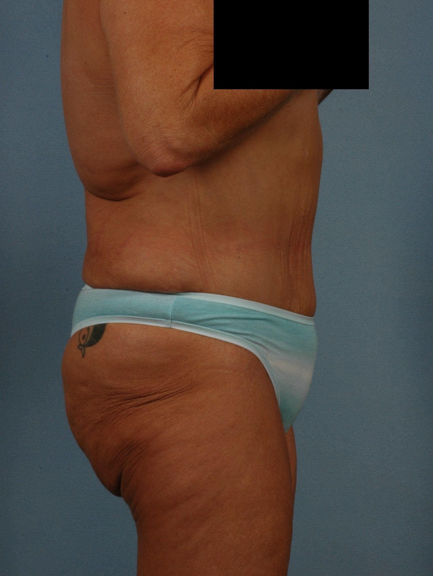 Abdominoplasty Patient Photo - Case 11765 - after view-1