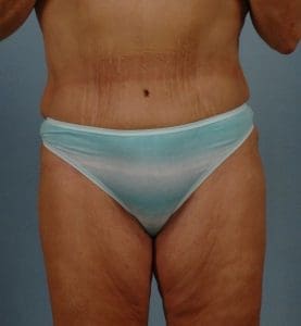 Abdominoplasty - Case 11765 - After