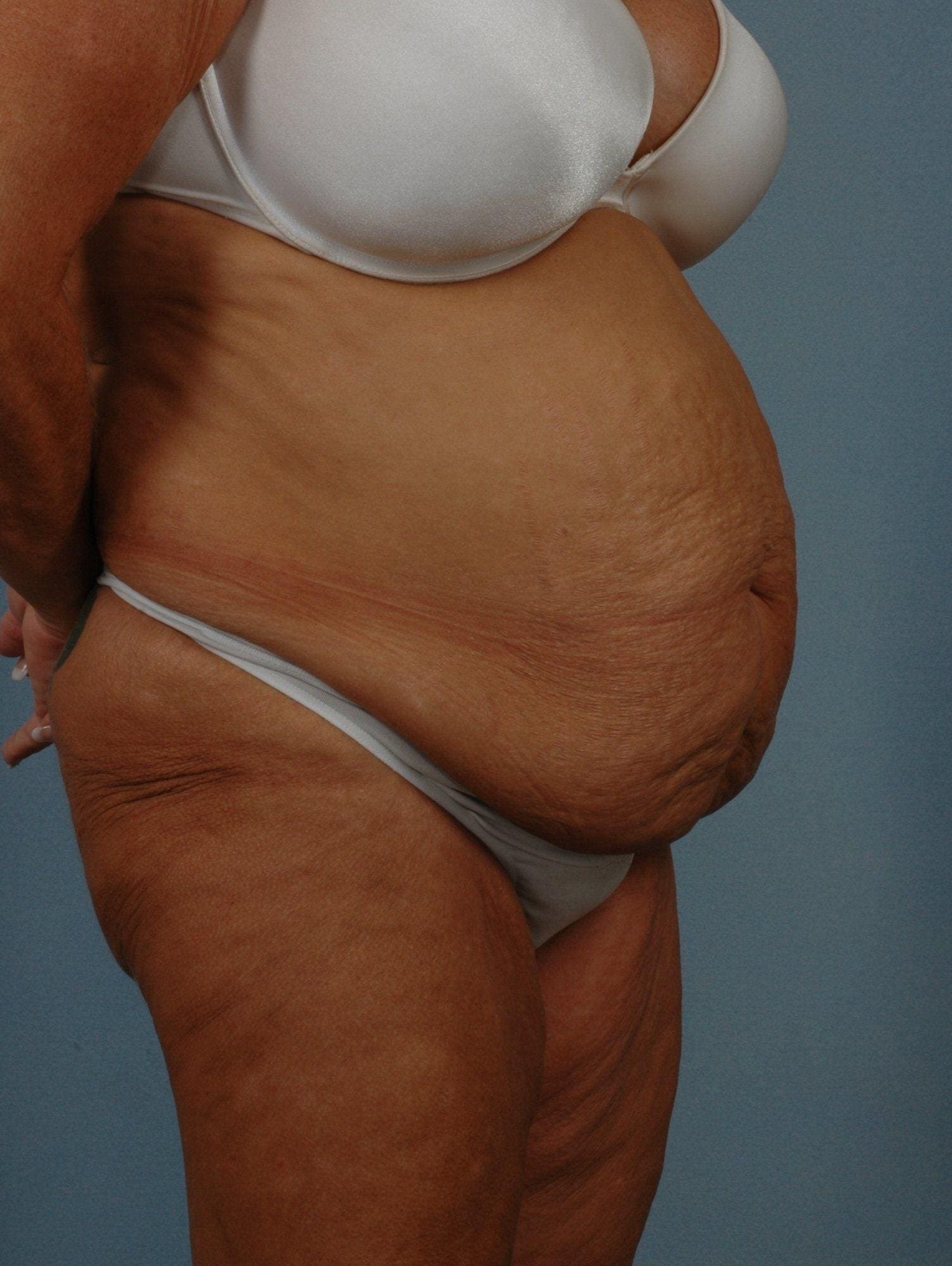 Abdominoplasty Patient Photo - Case 11765 - before view-4