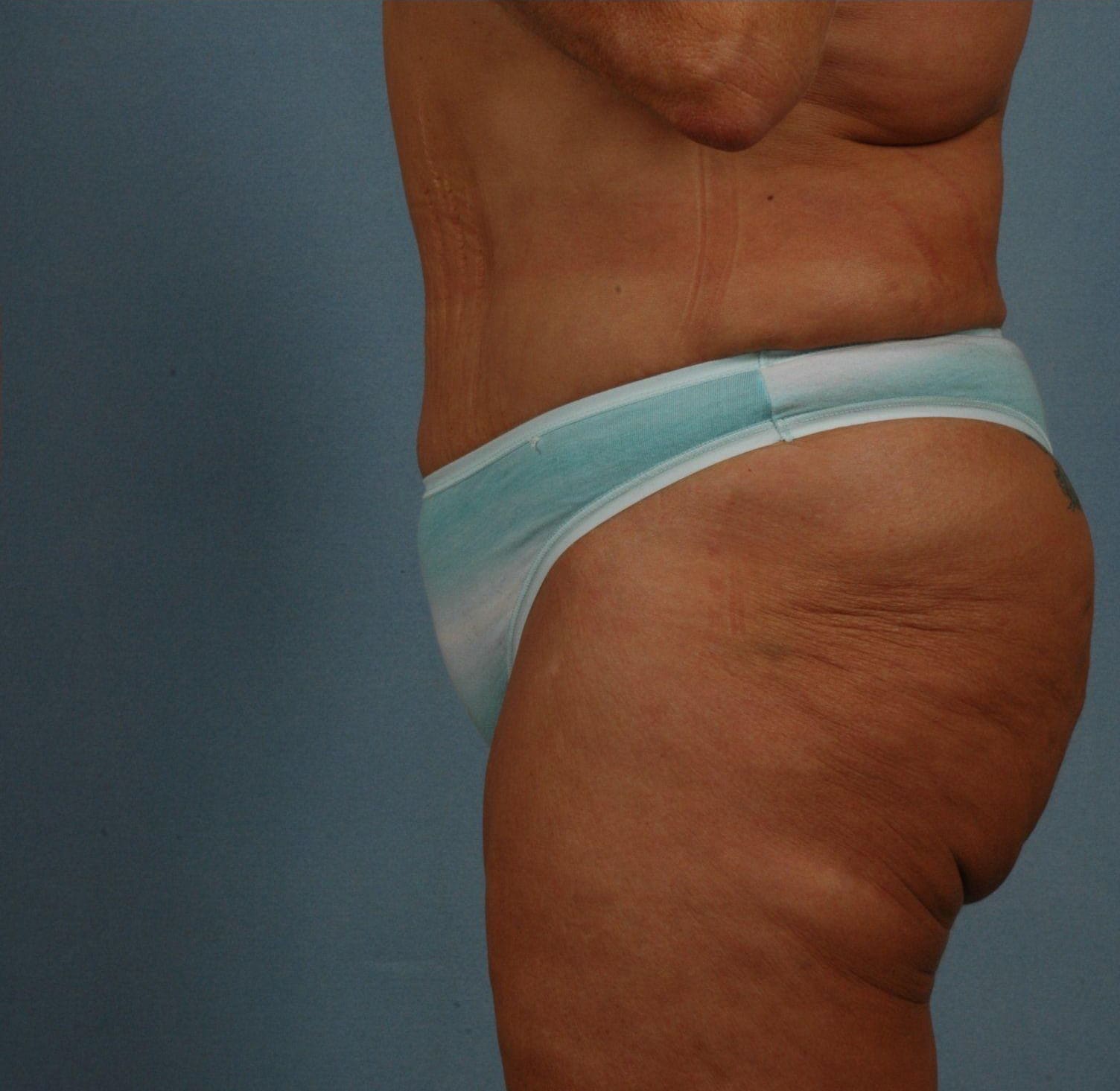 Abdominoplasty Patient Photo - Case 11765 - after view-5