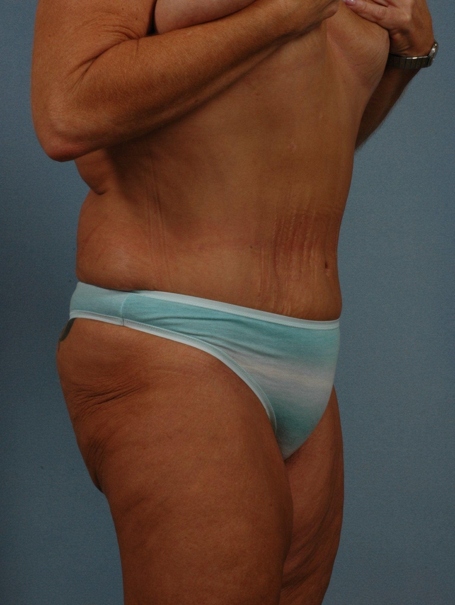 Abdominoplasty Patient Photo - Case 11765 - after view-4