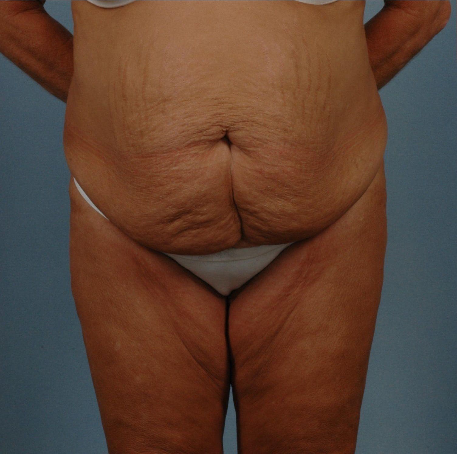 Abdominoplasty Patient Photo - Case 11765 - before view-6