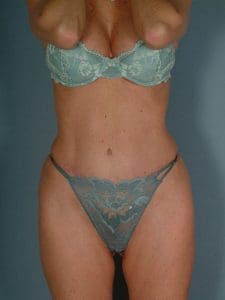 Abdominoplasty - Case 11801 - After