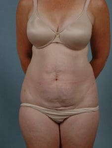 Abdominoplasty - Case 11819 - Before