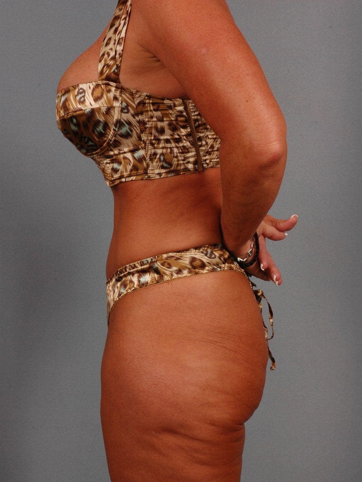 Abdominoplasty Patient Photo - Case 11825 - after view-1