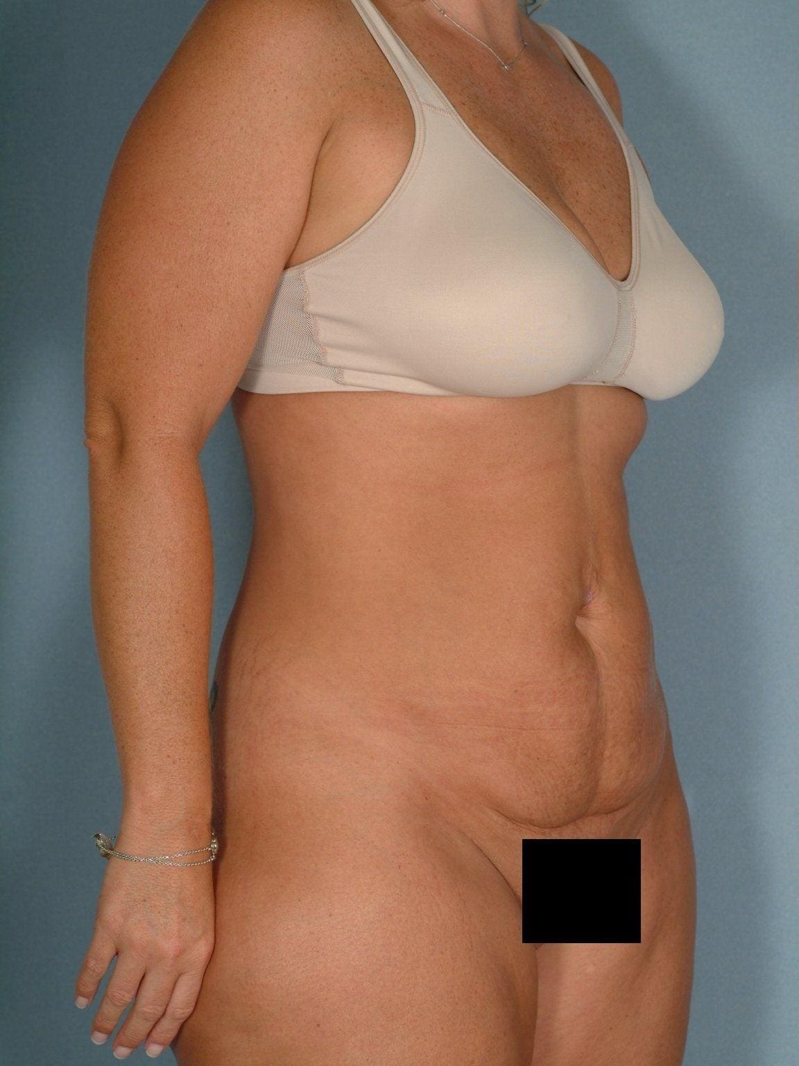 Abdominoplasty Patient Photo - Case 11825 - before view-4