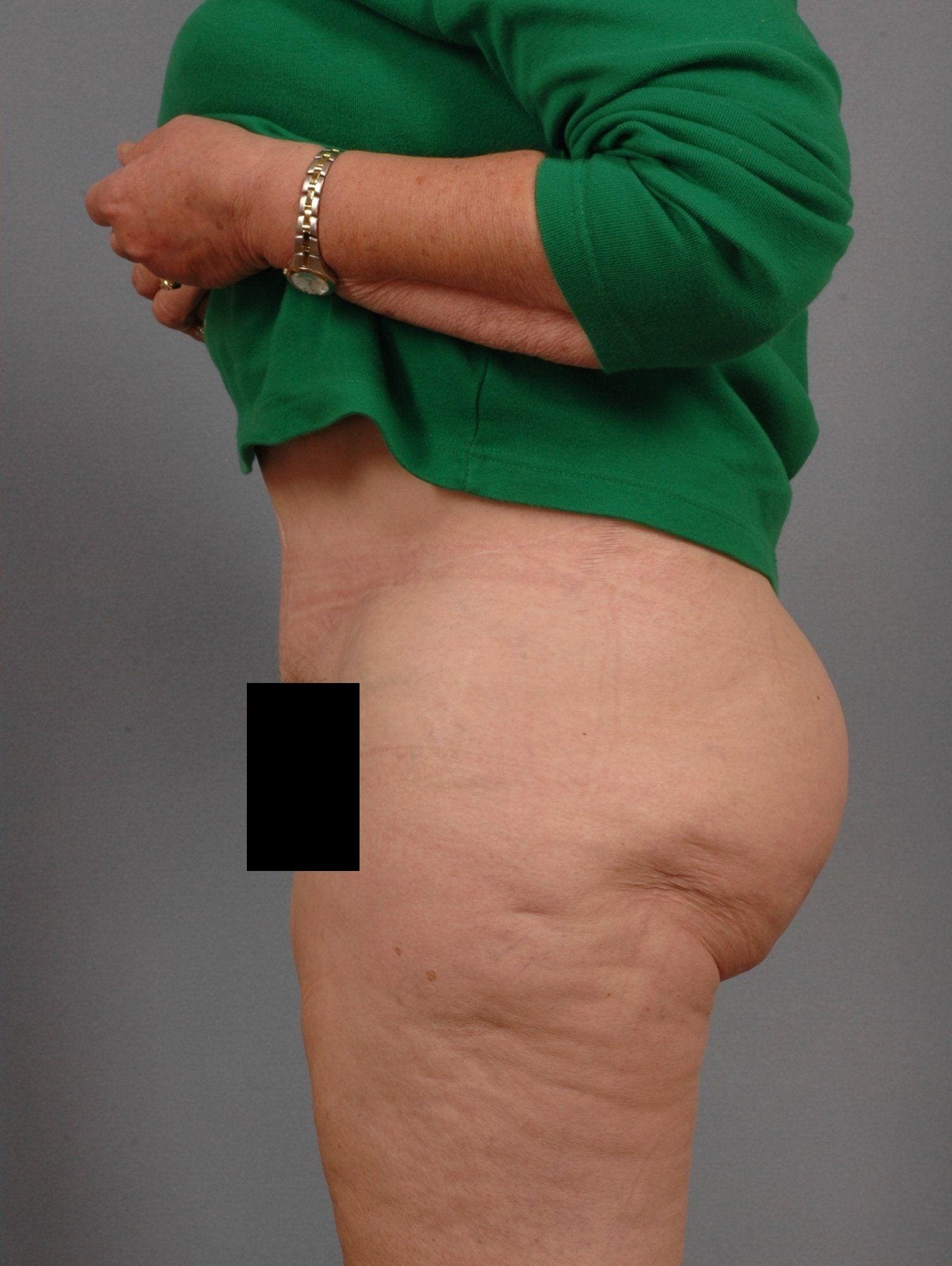 Abdominoplasty Patient Photo - Case 11845 - after view-1