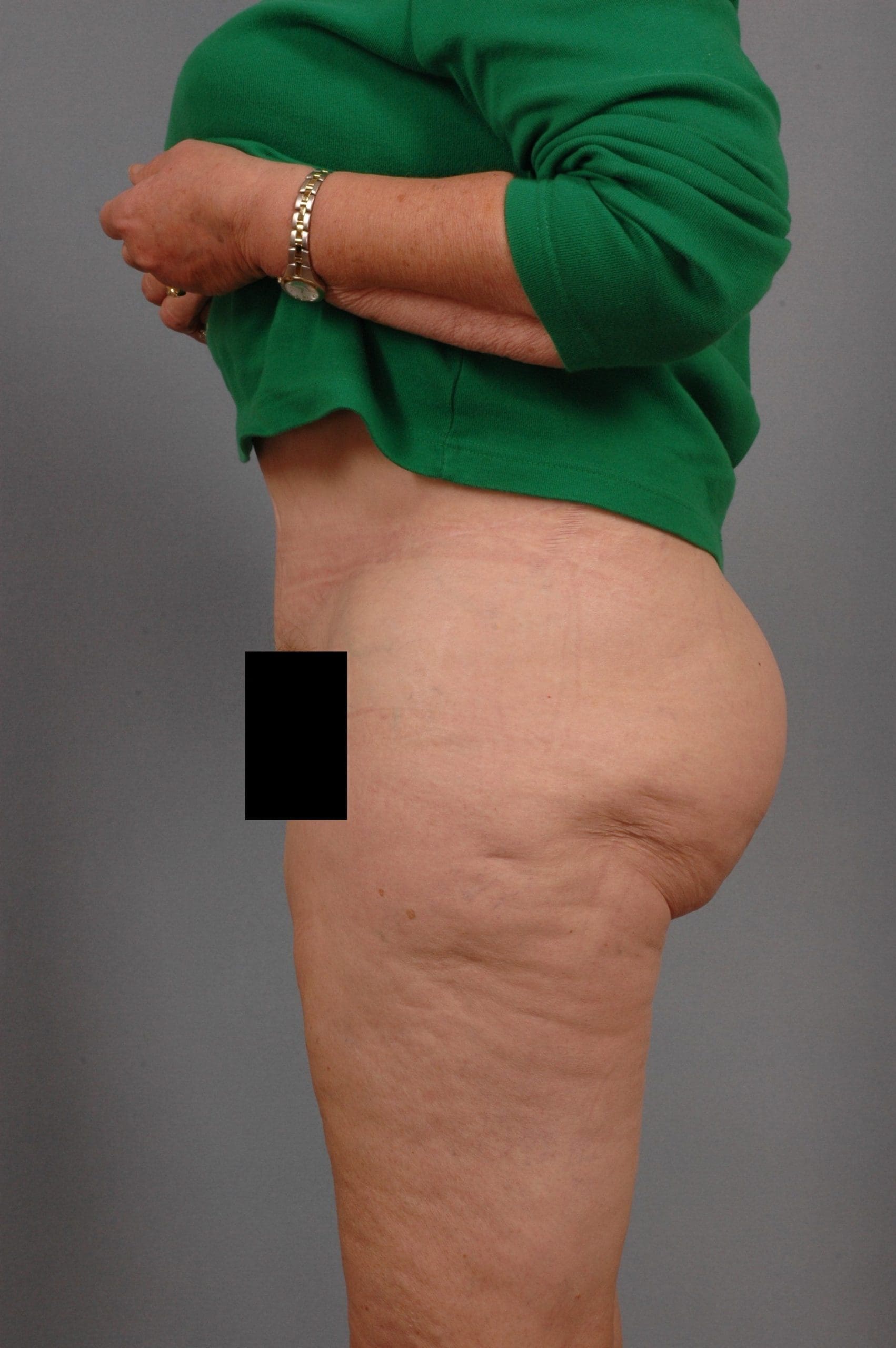 Abdominoplasty Patient Photo - Case 11845 - after view-5