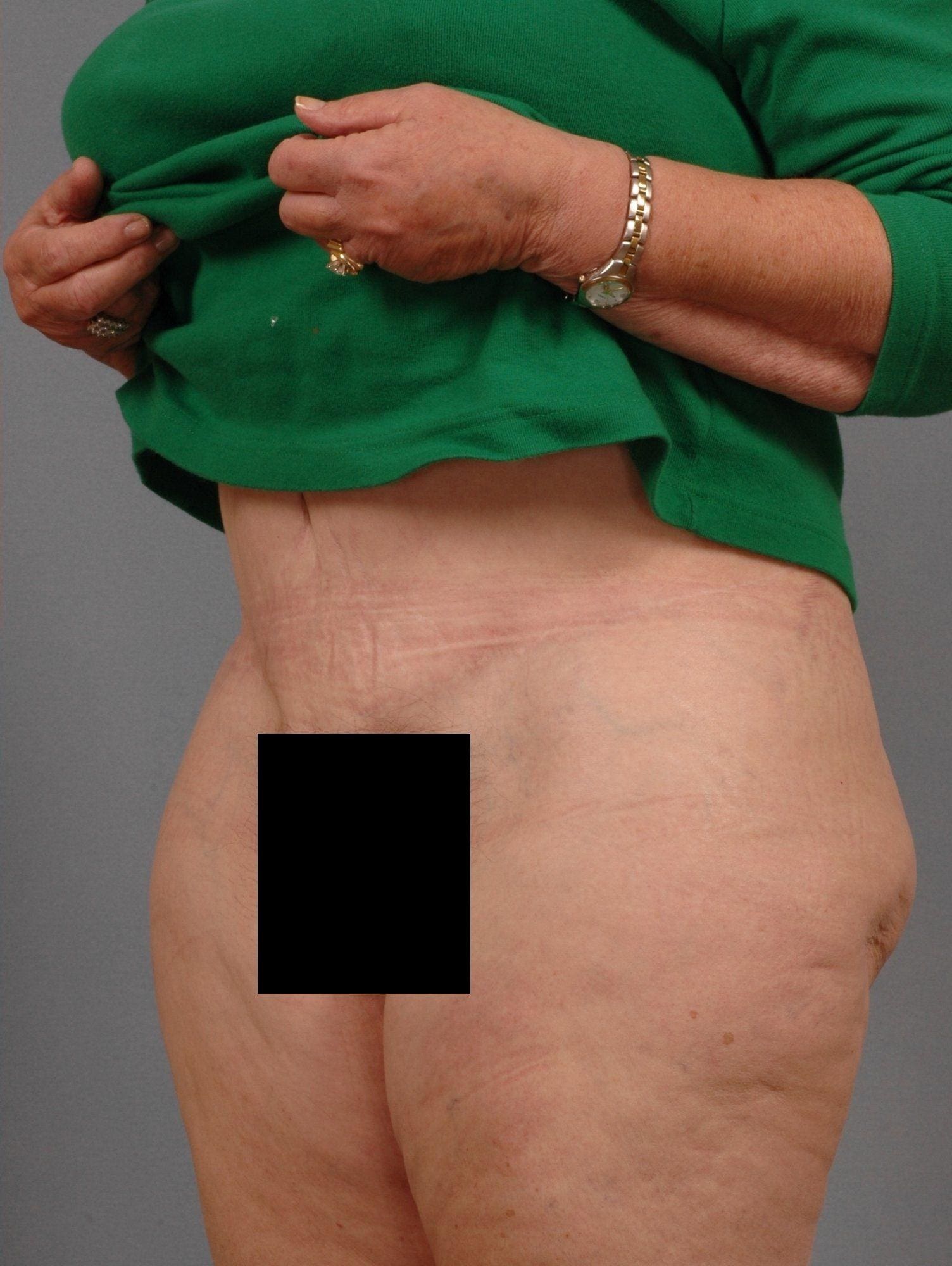 Abdominoplasty Patient Photo - Case 11845 - after view-3