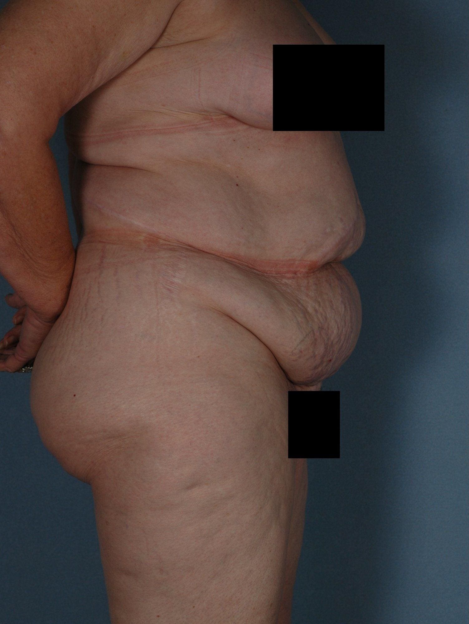 Abdominoplasty Patient Photo - Case 11845 - before view-2