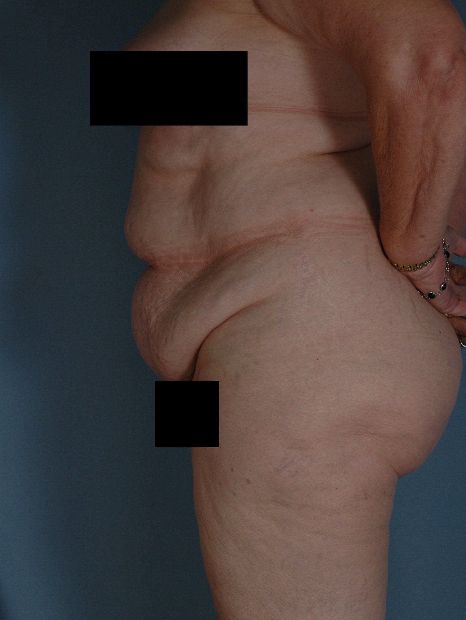 Abdominoplasty Patient Photo - Case 11845 - before view-1