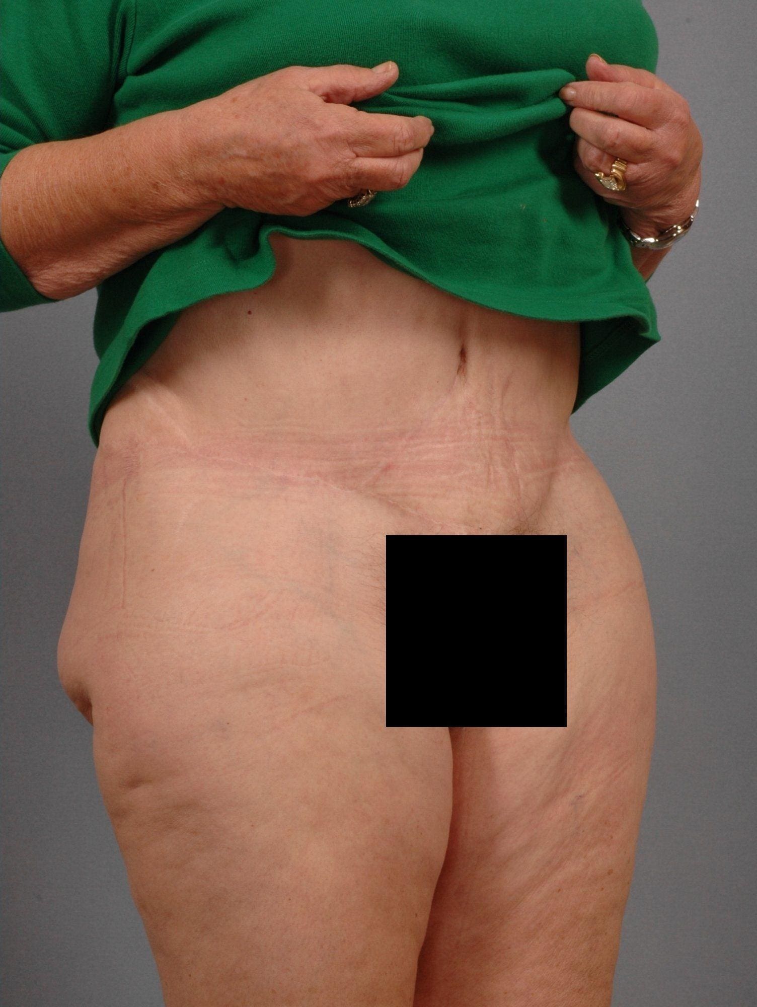 Abdominoplasty Patient Photo - Case 11845 - after view-4
