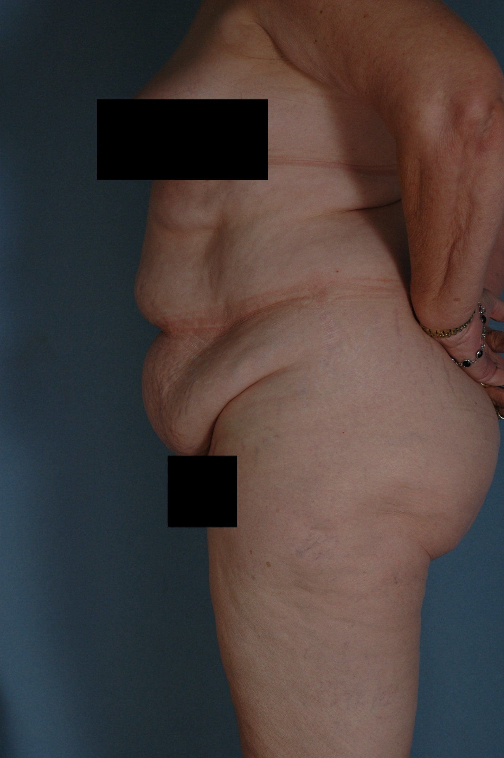 Abdominoplasty Patient Photo - Case 11845 - before view-5