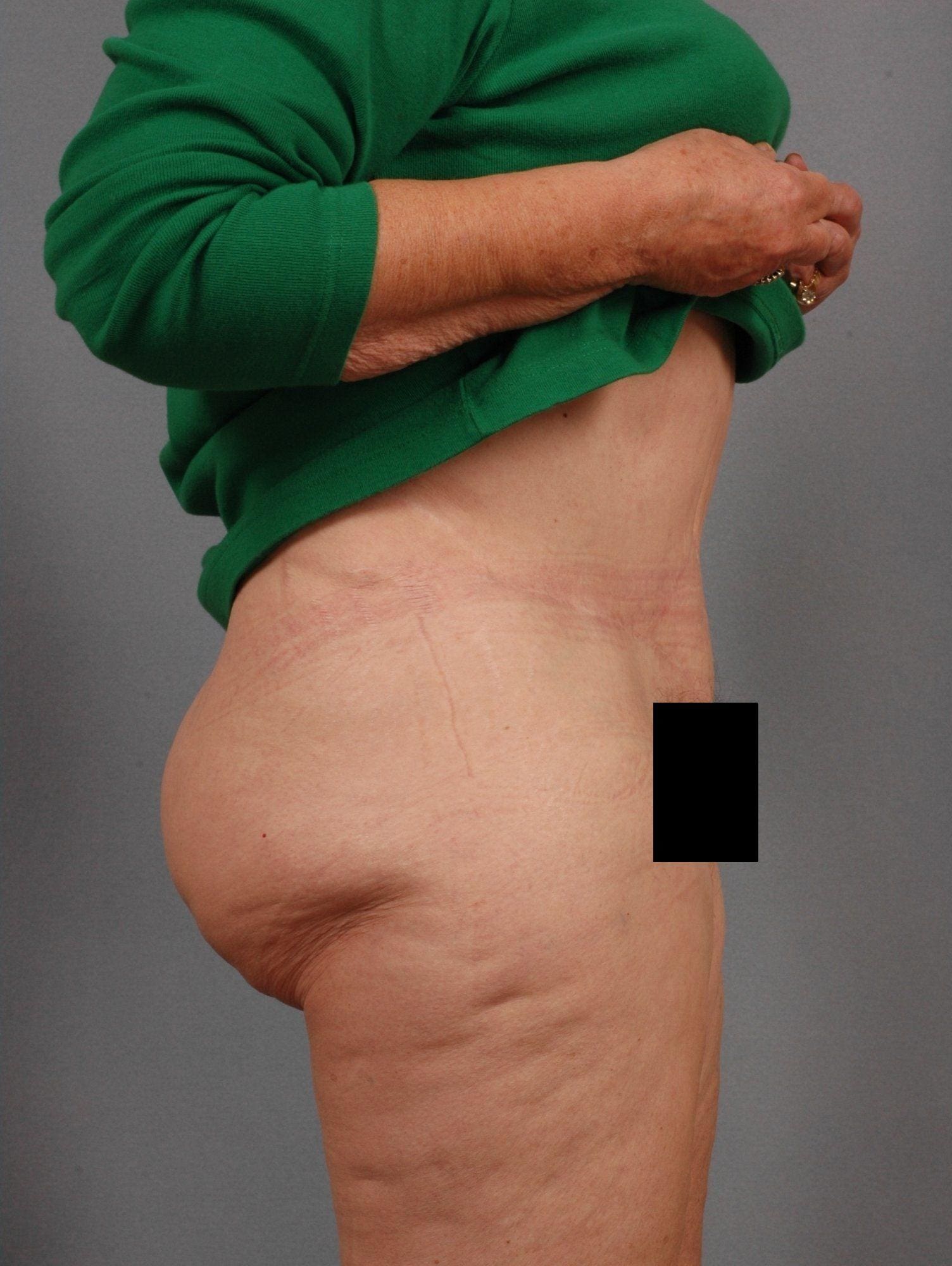 Abdominoplasty Patient Photo - Case 11845 - after view-2