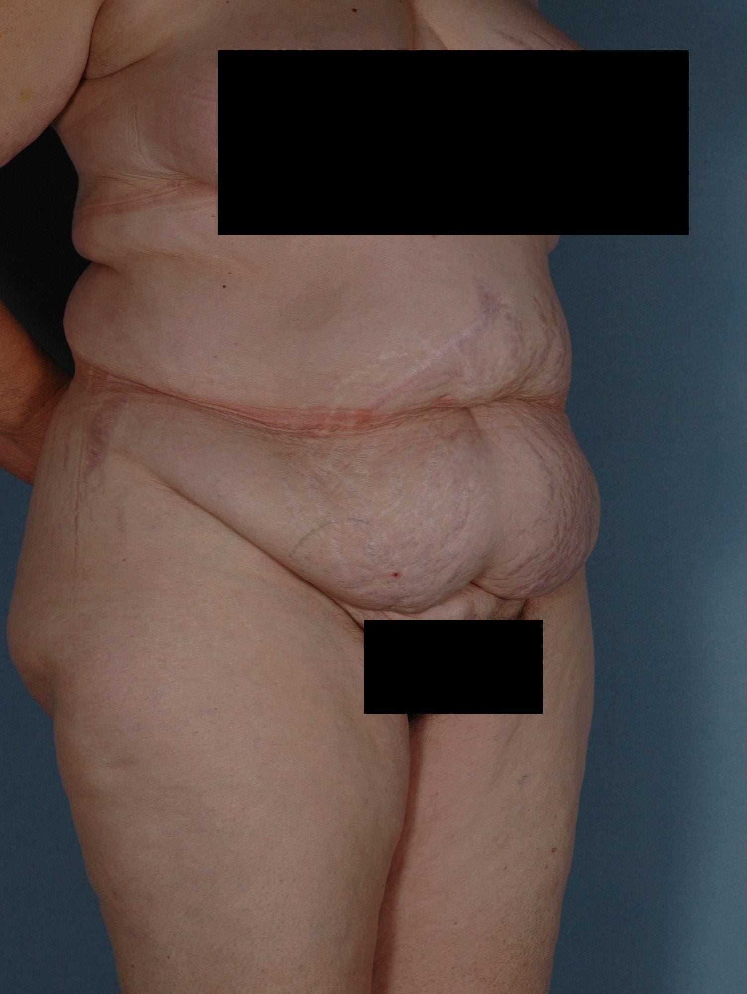 Abdominoplasty Patient Photo - Case 11845 - before view-4