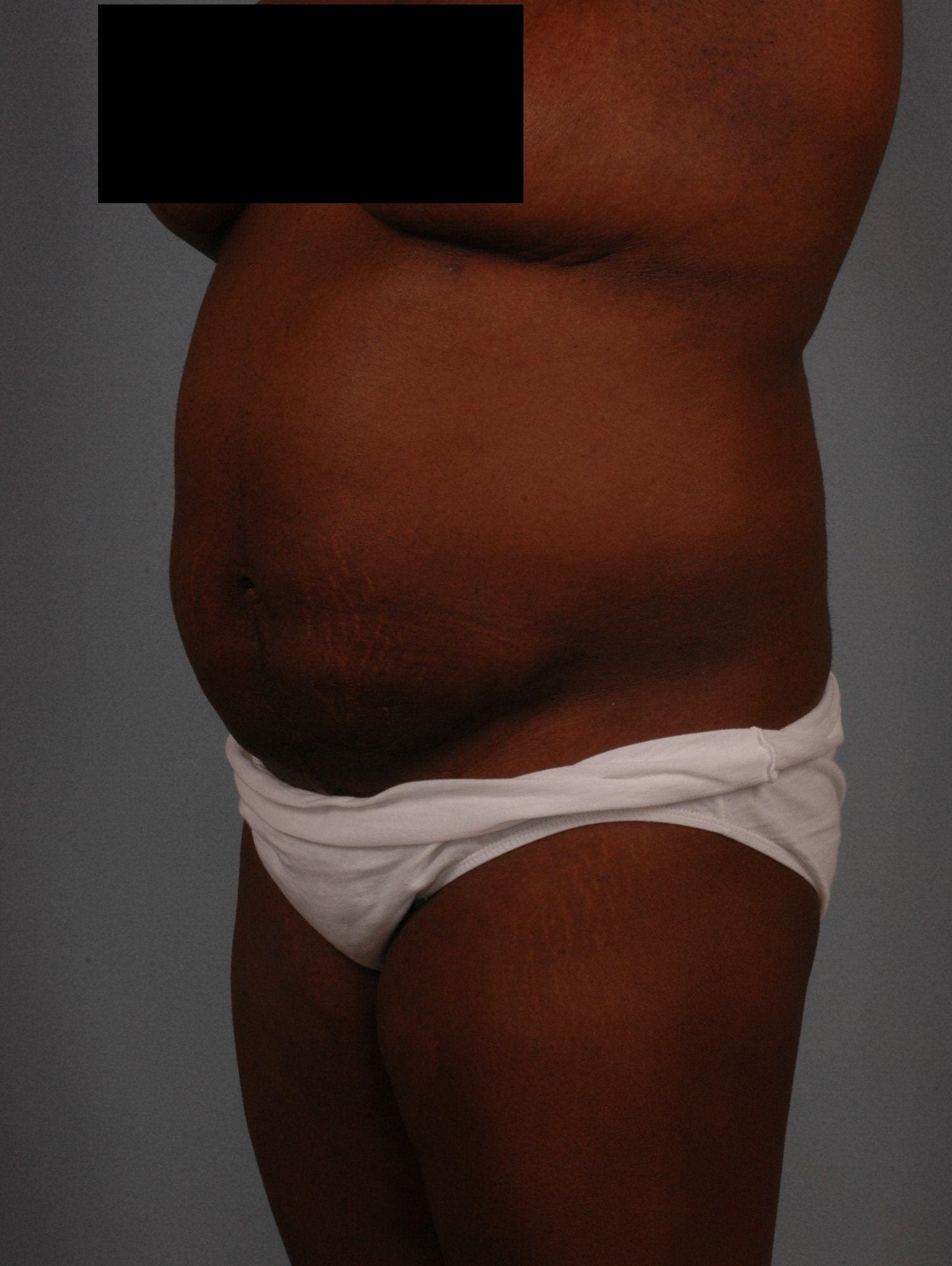 Abdominoplasty Patient Photo - Case 11877 - after view-3