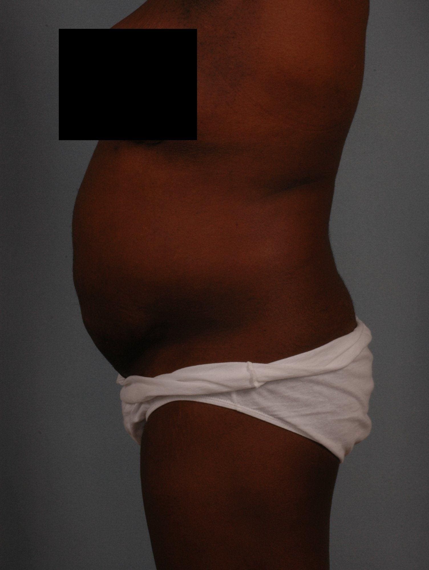 Abdominoplasty Patient Photo - Case 11877 - after view-1