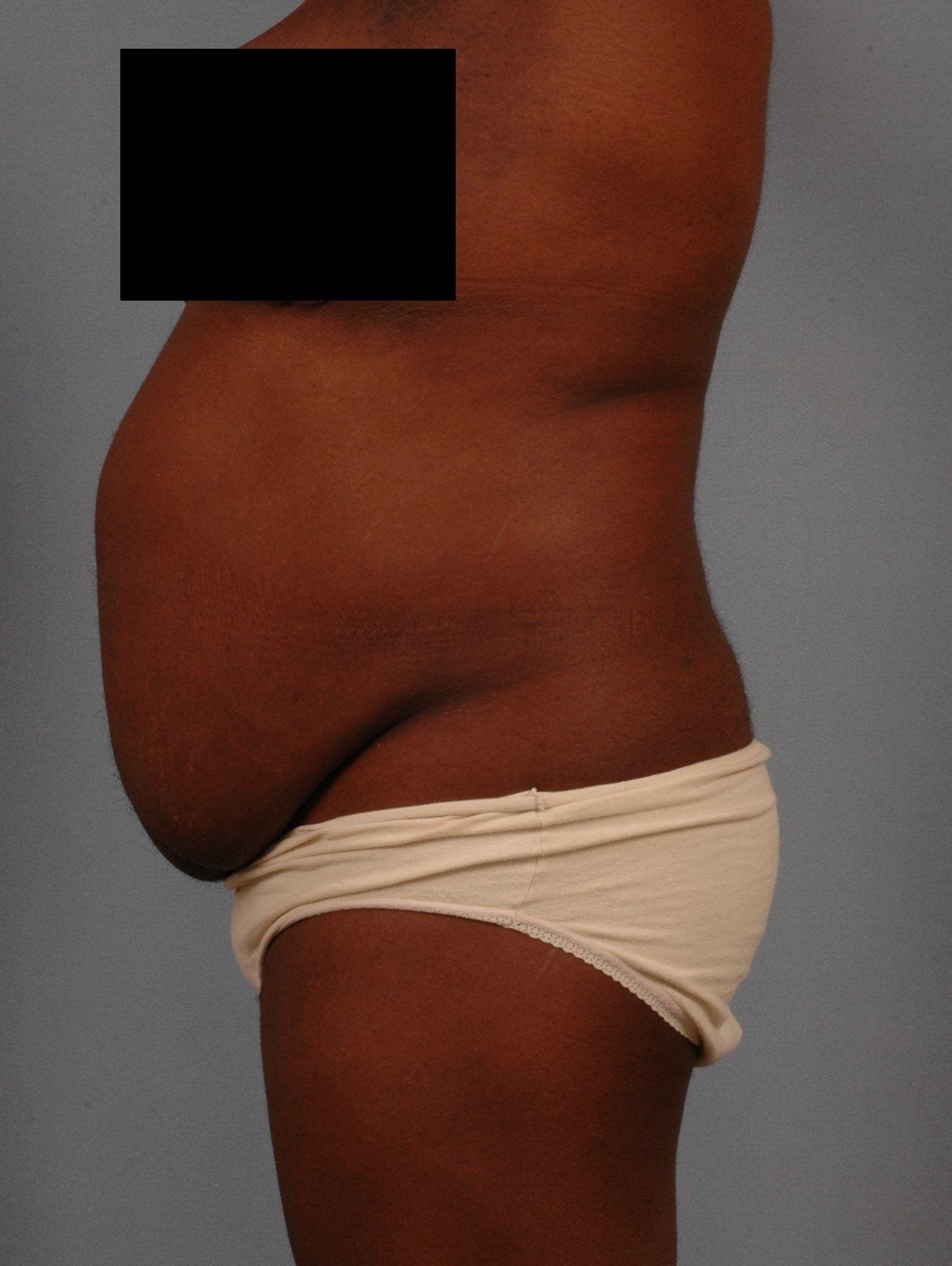 Abdominoplasty Patient Photo - Case 11877 - before view-1