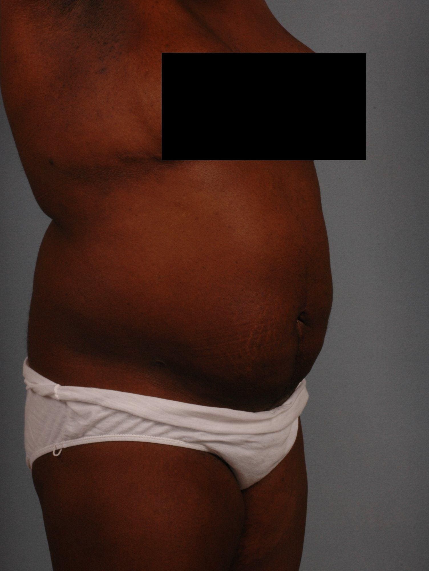 Abdominoplasty Patient Photo - Case 11877 - after view-4