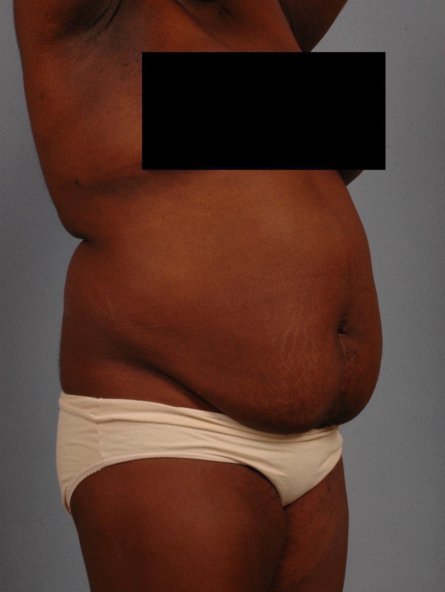 Abdominoplasty Patient Photo - Case 11877 - before view-4