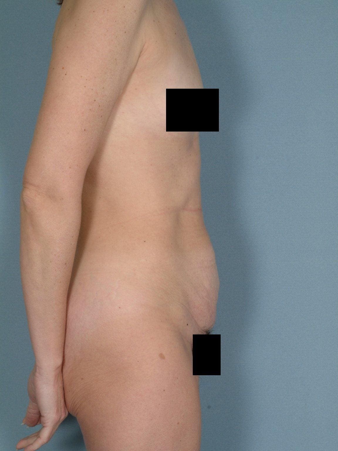 Abdominoplasty Patient Photo - Case 11885 - before view-2