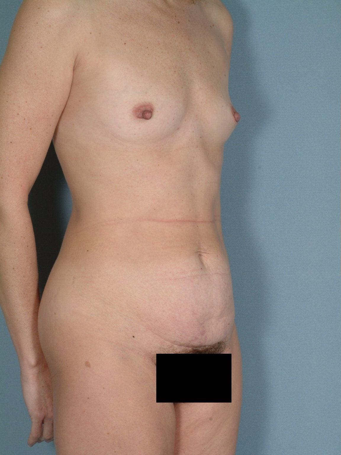 Abdominoplasty Patient Photo - Case 11885 - before view-4