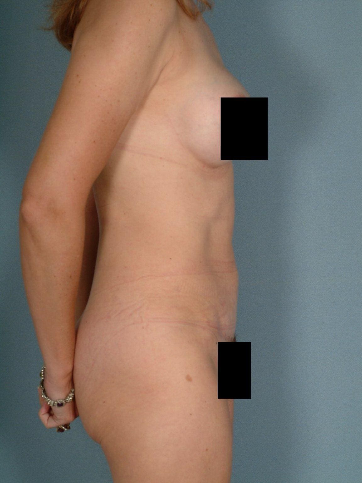 Abdominoplasty Patient Photo - Case 11885 - after view-2