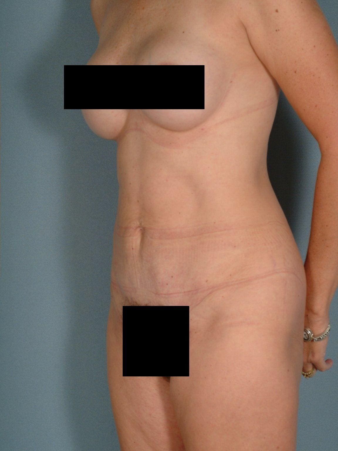 Abdominoplasty Patient Photo - Case 11885 - after view-3
