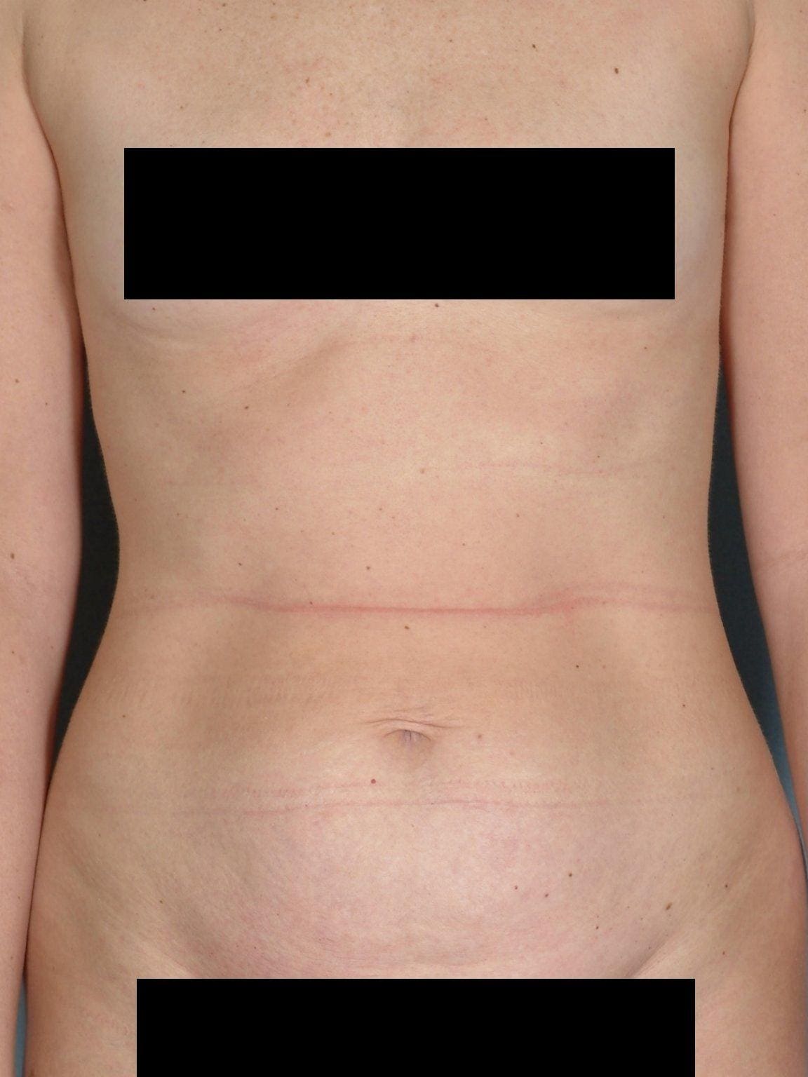Abdominoplasty Patient Photo - Case 11885 - before view-5