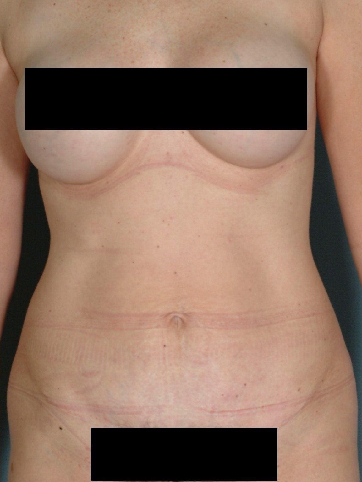 Abdominoplasty Patient Photo - Case 11885 - after view-5