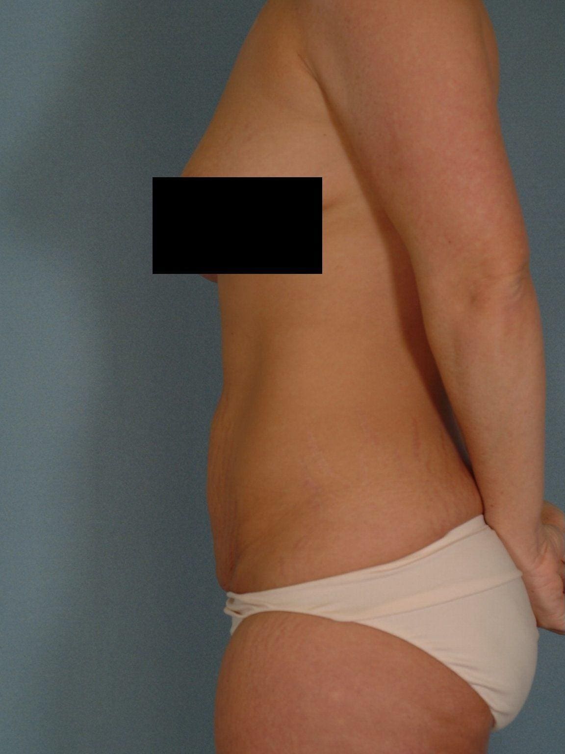 Abdominoplasty Patient Photo - Case 11901 - before view-1