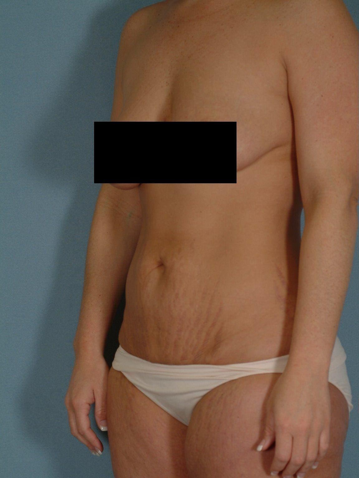 Abdominoplasty Patient Photo - Case 11901 - before view-3