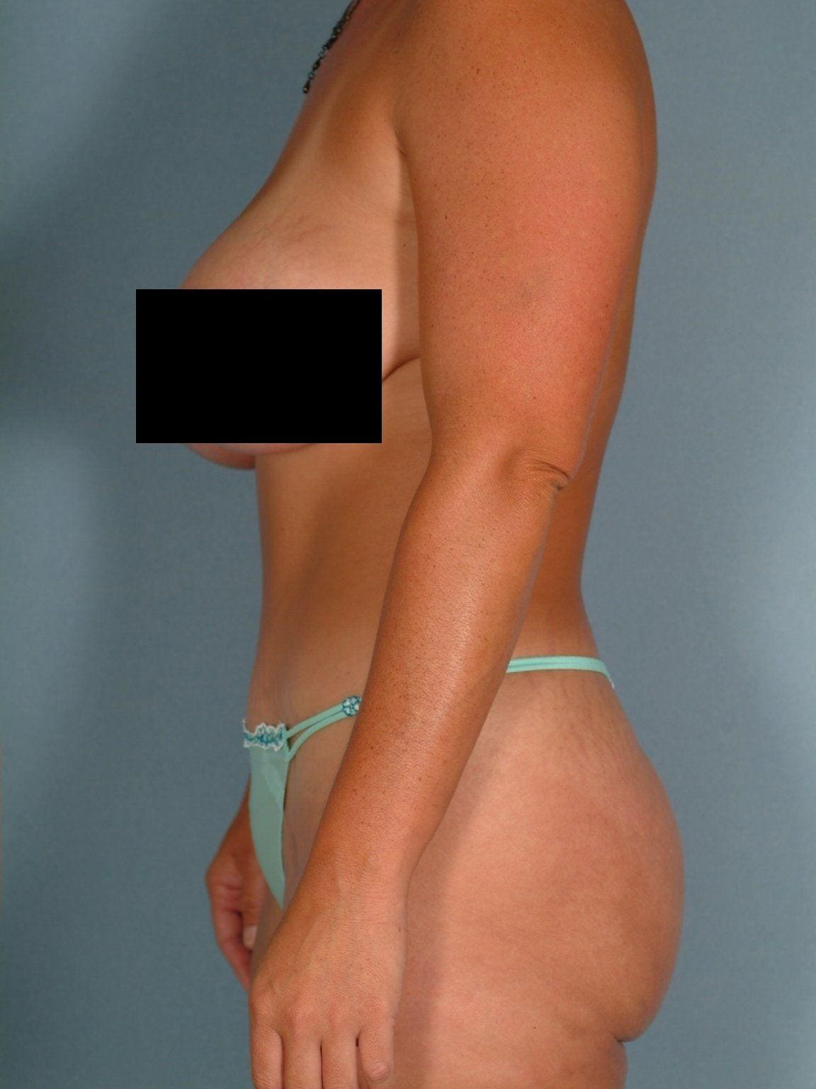 Abdominoplasty Patient Photo - Case 11901 - after view-1