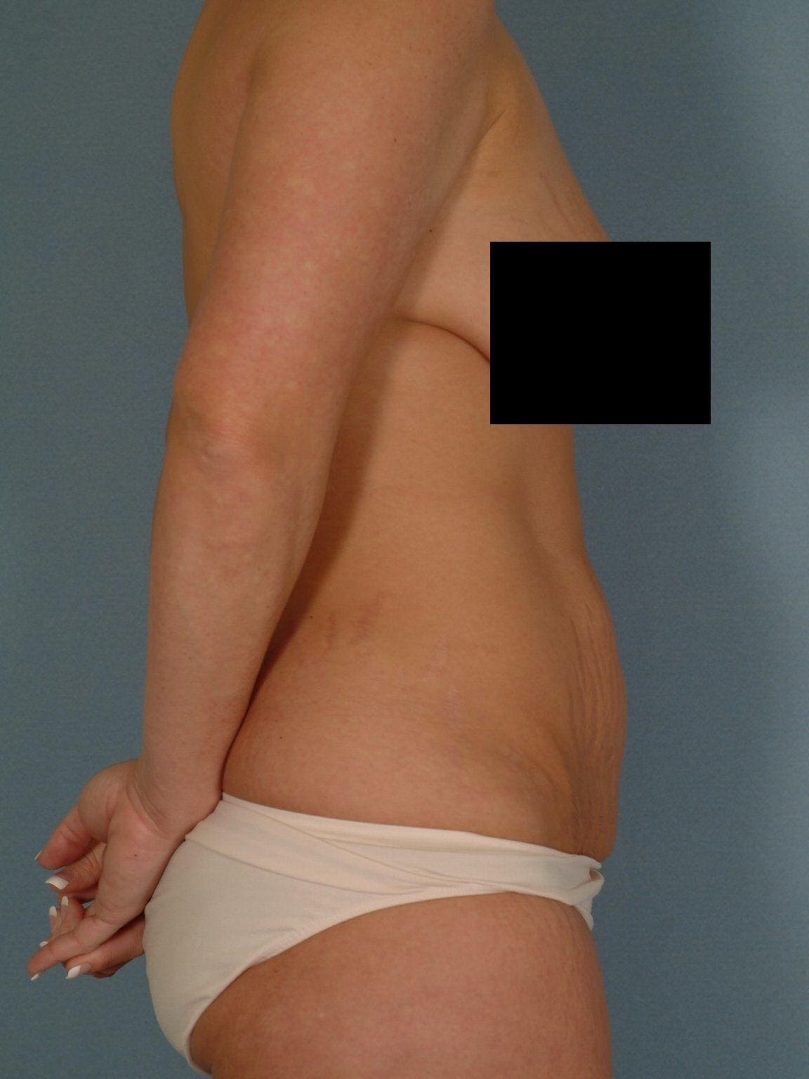 Abdominoplasty Patient Photo - Case 11901 - before view-2
