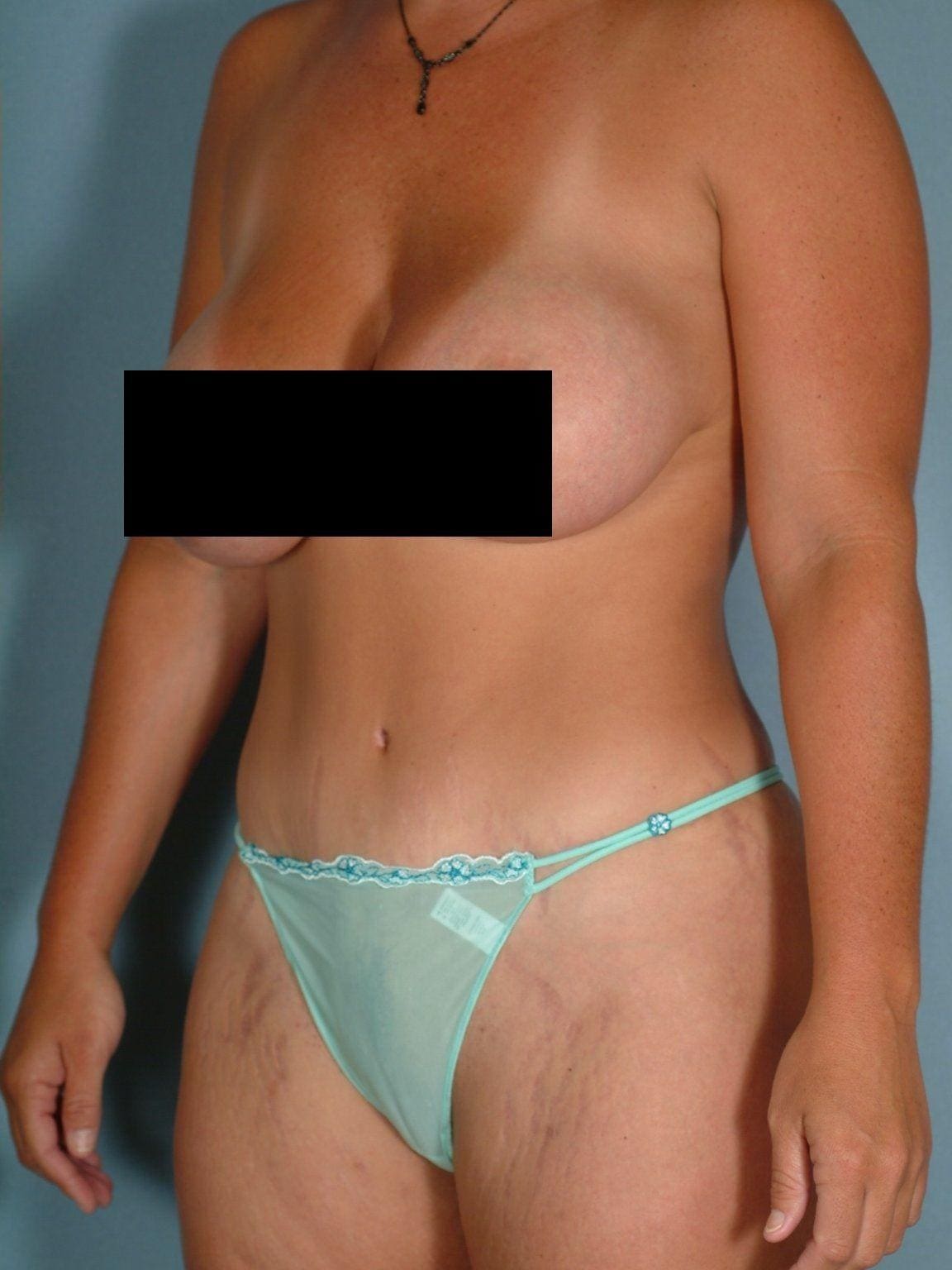 Abdominoplasty Patient Photo - Case 11901 - after view-3