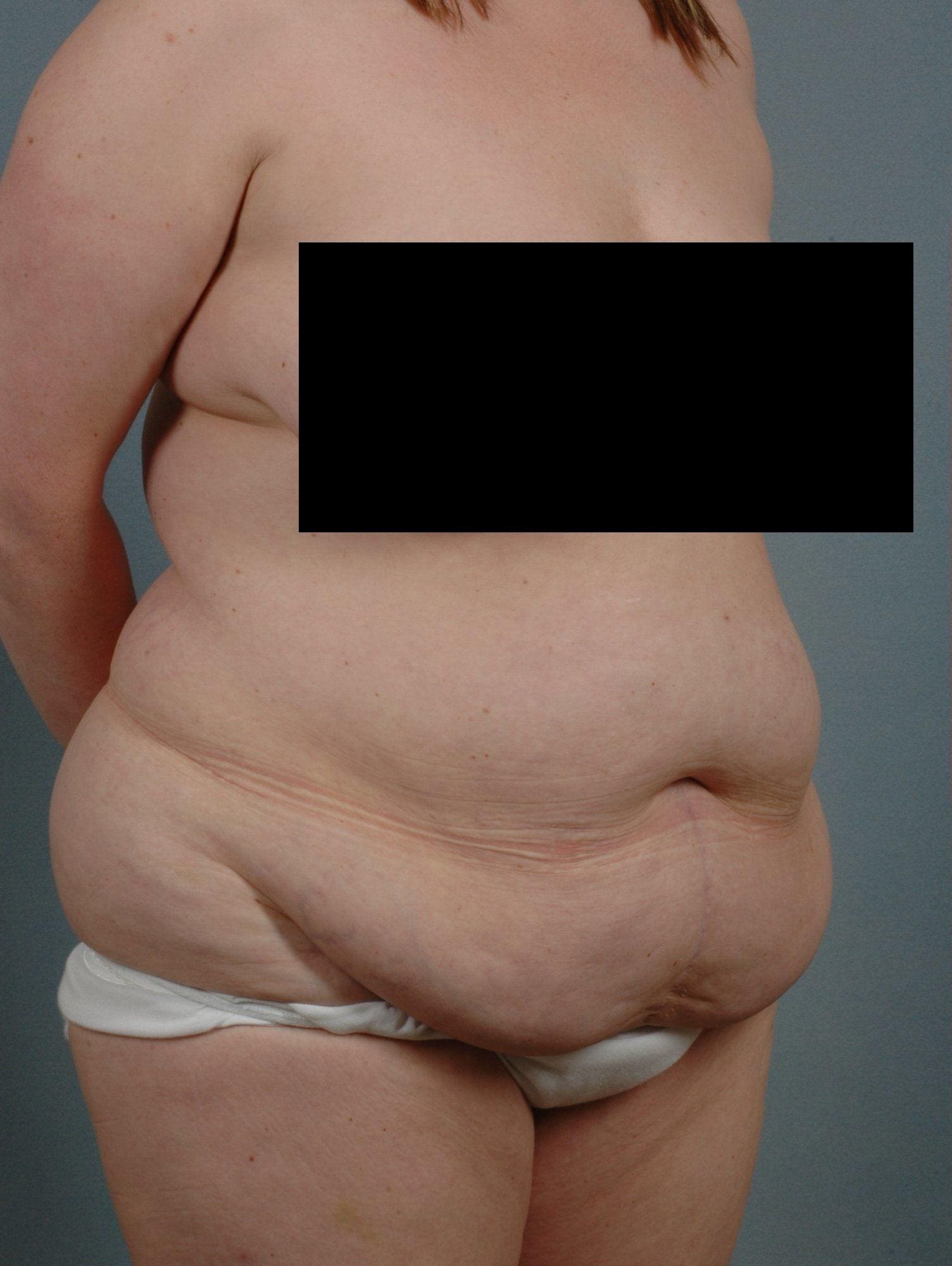 Abdominoplasty Patient Photo - Case 11911 - before view-4
