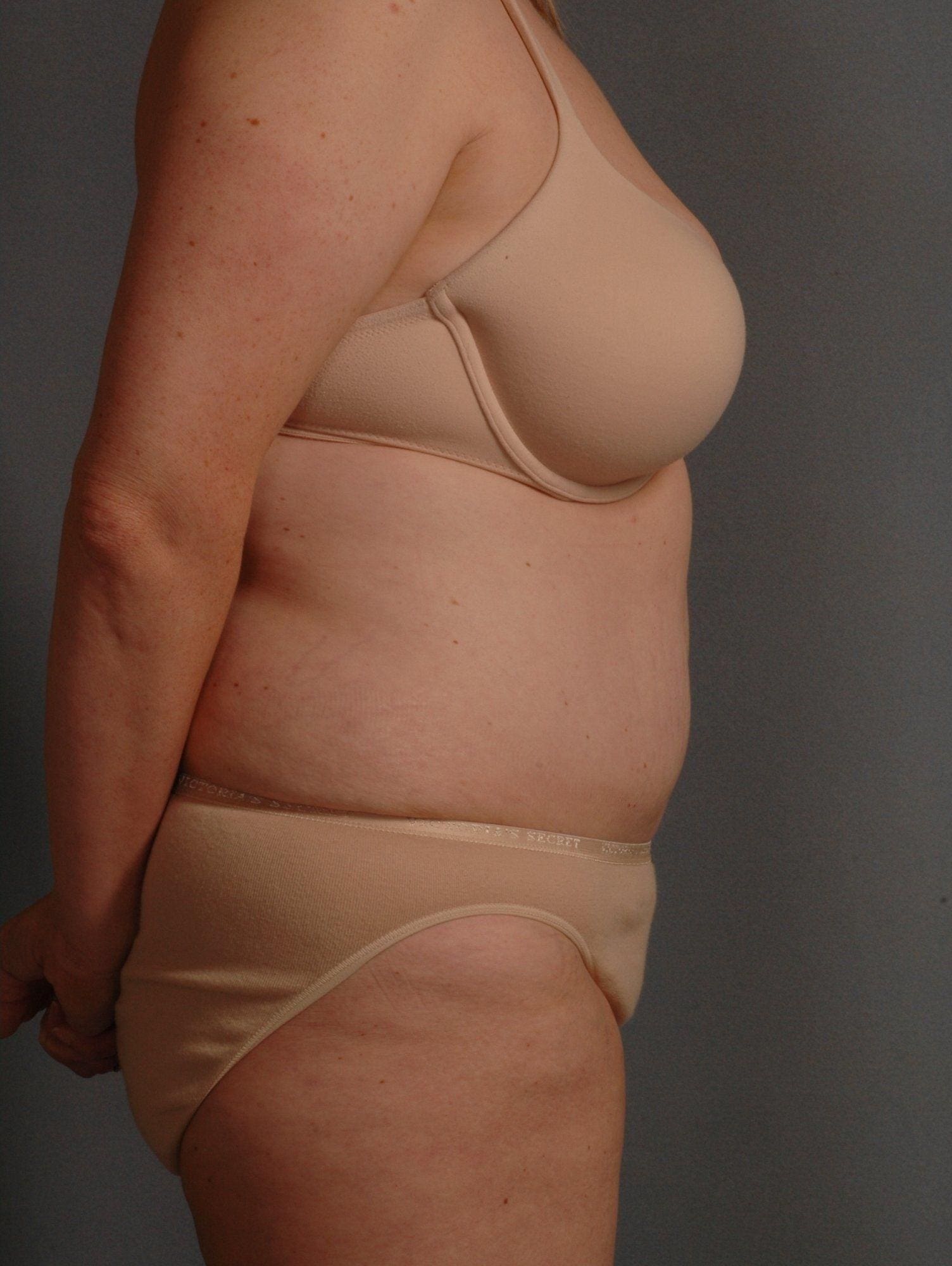 Abdominoplasty Patient Photo - Case 11911 - after view-2