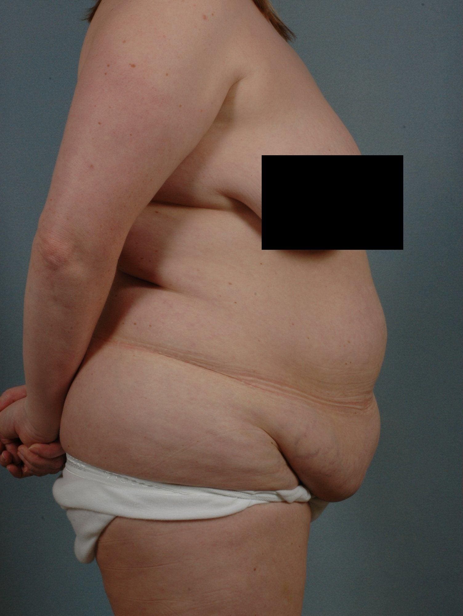 Abdominoplasty Patient Photo - Case 11911 - before view-2