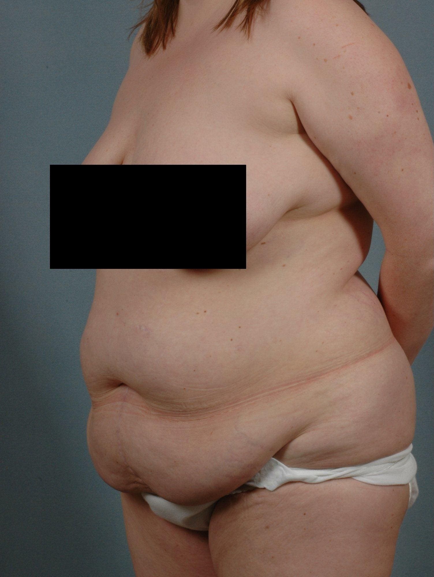 Abdominoplasty Patient Photo - Case 11911 - before view-3