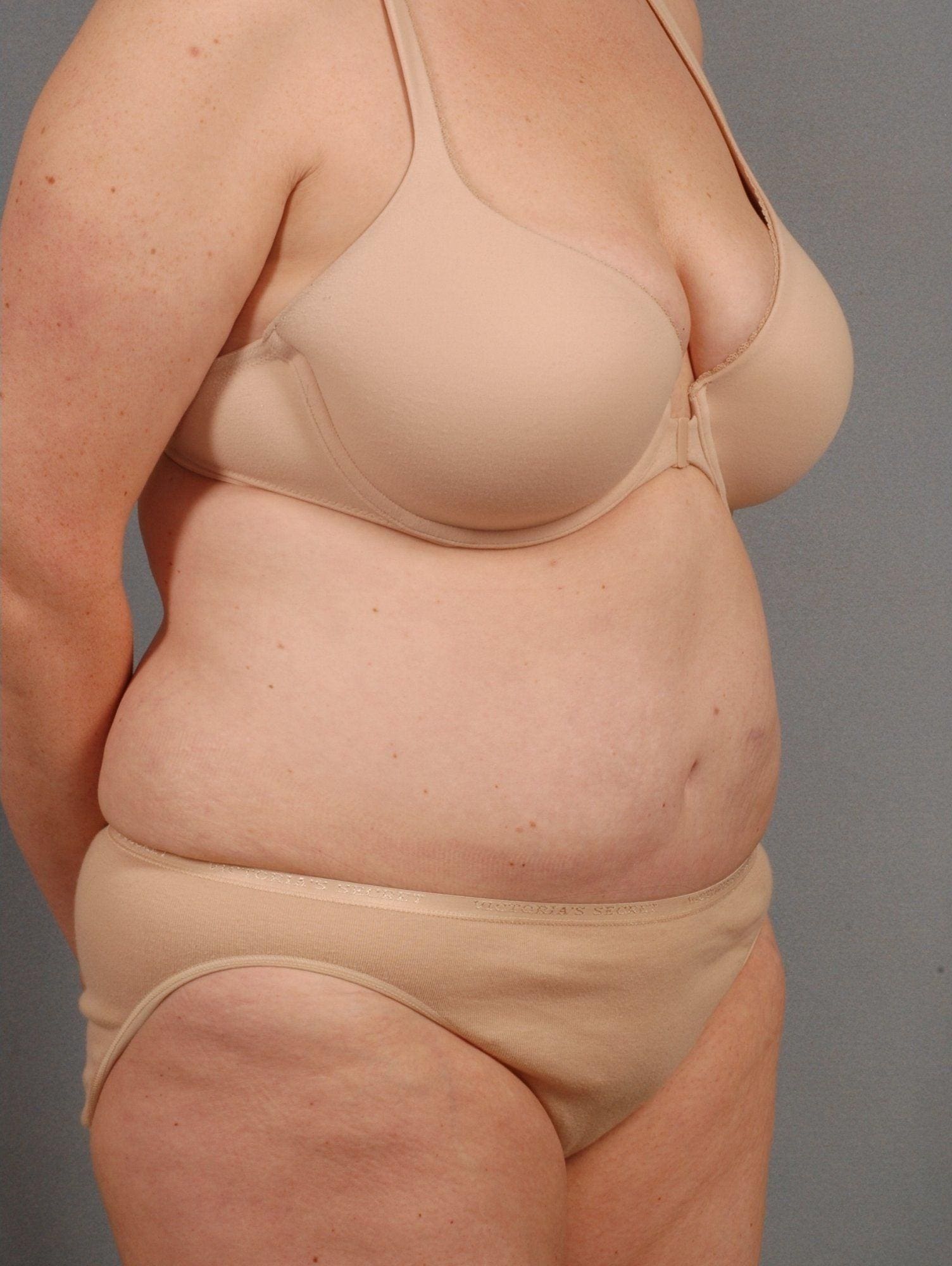 Abdominoplasty Patient Photo - Case 11911 - after view-4