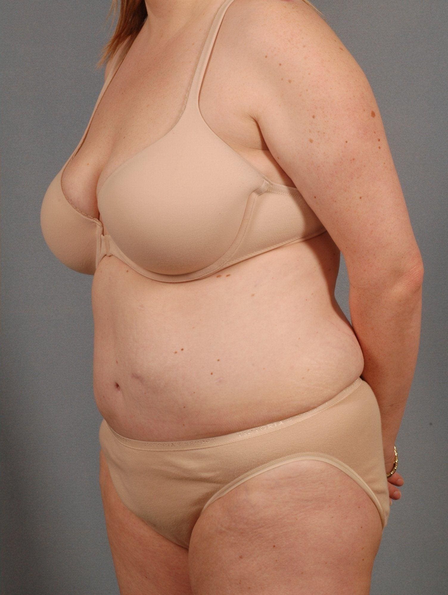 Abdominoplasty Patient Photo - Case 11911 - after view-3