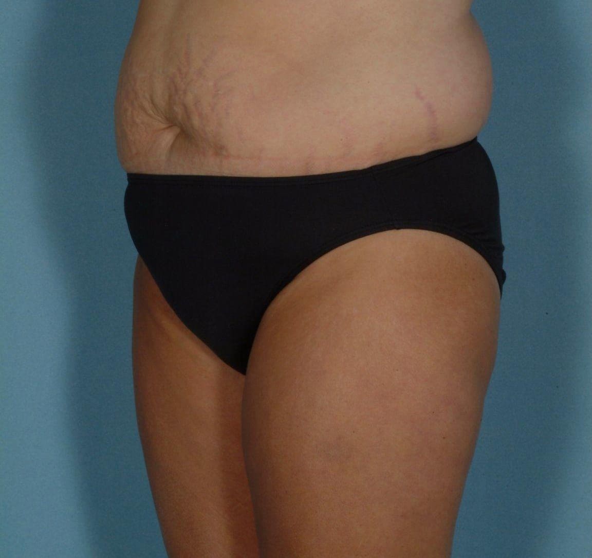 Abdominoplasty Patient Photo - Case 11923 - before view-3